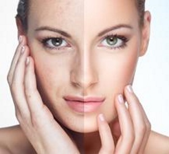  acide hyaluronique